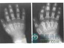 软骨发育不全最新治疗方法研究进展
